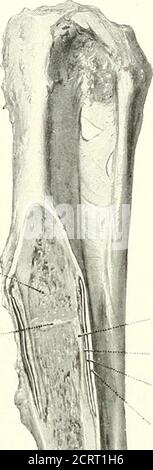 . Sur les méthodes modernes de traitement des fractures . fixation. Il s'agit également d'une couche mince distincte d'externalcallus sur la surface externe du bonesous la plaque. Au site de la fracturation, une réparation féble a eu lieu, par le tissu cartilagineux. La partie dense de l'arbre de l'os a été presque entièrement remplacée par un tissu spongieux ouvert, il y a la coque mince possible de l'os compact gauche. C'est un callus externe, bien que. Banque D'Images