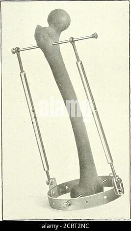 . Sur les méthodes modernes de traitement des fractures . f les fragments ont été découverts après les rayons X, une telle erreur n'a pas pu être corrigée sans sortir et ré-appliquer l'une des broches. J'ai essayé de surmonter ces difficultés par l'adoption d'une sorte de joint à rotule à chacun des quatre angles de l'enchevêtrement, capable de fixation par vis et écrous. Mais il était impossible de fixer ce soétroitement qu'il ne serait pas lâche, et je ncAcrused. C'est dans la recherche d'une modificationde la double transfixionmethod qui serait applicable à la fcmiu.que j'ai résolu le problème Avorki Banque D'Images