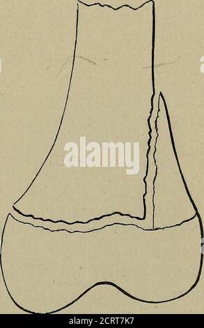 . Le Röntgen rayons dans le travail médical . Figure 72.—pur et complet Fig. 73.—séparation partielle, avec séparation. Fracture de la diaphyse. Banque D'Images
