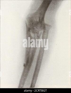 . American X-ray journal . fig. 6. L'aiguille, j'ai conclu qu'il doit bea caillot de sang dans l'oeil qui était prov-en correct que l'oeil a été enlevé et trouvé rempli de caillot. La pièce d'acier était dans le caillot. Figure 1 est une radiographie d'une épaule de M. K Residence, Guthrie, I. T., prise pour Dr. F. R. Smiley, Boonville, Missouri, montrant une balle sur thescapula. Le parti qui a tiré le pis-tol, un calibre trente-huit, était directement en face, la balle a frappé le 326 THE AMERICAN X-RAY JOURNAL. Clavicule et a dansé à l'endroit où il est pris dans la radiographie. Figure 2. Fracture de la base du cou de Banque D'Images