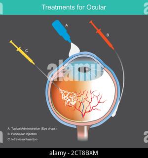 Traitements pour l'oculaire. Illustration expliquer le traitement des maladies rétiniennes causées par des vaisseaux sanguins anormaux de l'œil. Illustration de Vecteur