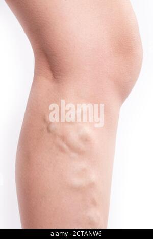 varices dans la jambe d'une femme gros plan isolé sur fond blanc. Banque D'Images