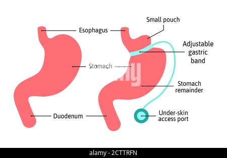 Diagramme d'illustration médicale anatomique de la bande gastrique. Chirurgie diviser l'estomac en deux parties avec la bande. Anatomie de l'estomac humaine isolée sur blanc Illustration de Vecteur