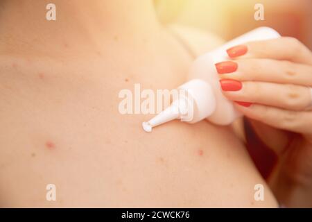 Femme appliquant de la crème sur la peau atteinte de la varicelle Banque D'Images