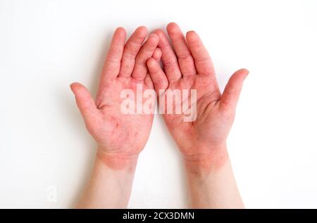 enfant de 4 ans rouge gonflement des mains de dermatite atopique fissurée causé par beaucoup de lavage des mains et de désinfection des mains pendant période pandémique covid-19 en 2020 Banque D'Images