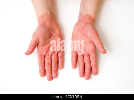 enfant de 4 ans rouge gonflement des mains de dermatite atopique fissurée causé par beaucoup de lavage des mains et de désinfection des mains pendant période pandémique covid-19 en 2020 Banque D'Images