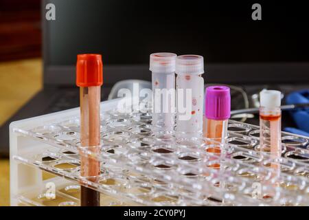 Un échantillon de sang avec en laboratoire pour vérifier l'échantillonnage tube placé sur le bureau Banque D'Images