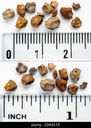 Fragments d'une pierre de rein. La pierre du rein se décompose par la lithotripsie extracorporelle à onde de choc (ESWL). Echelle en centimètres et pouces Banque D'Images