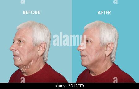 Le levage mâle avant et après les procédures en plastique Banque D'Images