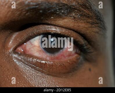 Yeux rouges. Un Indien. Gros plan des yeux rouges agacés d'un homme touché par la conjonctivite ou après la grippe, le rhume ou l'allergie. Maladie et traitement. Banque D'Images