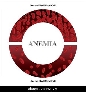 Anémie quantité de sang rouge carence en fer anémie différence d'anémie quantité de globules rouges et symptômes normaux illustration du vecteur médical. Illustration de Vecteur