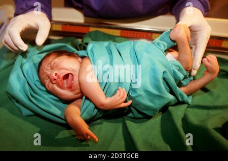 Peruvian One Month Old Baby Moises Chavez Known As The Lobster Baby Because Of A Rare Condition In Which His Arms And Legs Are Wrapped Like Claws Around His Body Is Shown To The