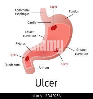 Ulcère peptique de l'estomac, anatomie microscopique colorée sur fond blanc. L'illustration du vecteur médical avec toutes les pièces internes est marquée par Illustration de Vecteur