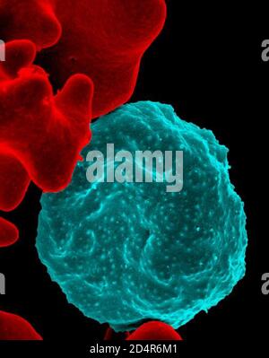 Micrographe électronique à balayage colorisé des globules rouges infectés par les parasites du paludisme, qui sont colorisés en bleu, la cellule infectée se trouve dans le cen Banque D'Images