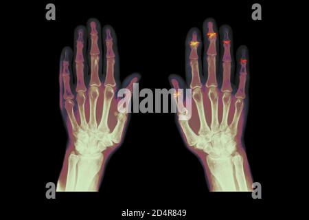 Rayons X colorés d'une main affectée par l'arthrite interphalangienne, les articulations touchées deviennent extrêmement douloureuses et déformées. Banque D'Images