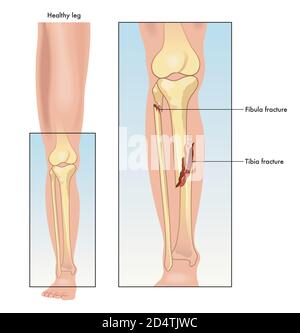 Illustration médicale comparant une jambe en bonne santé à une jambe avec un tibia et un péroné fracturés. Illustration de Vecteur