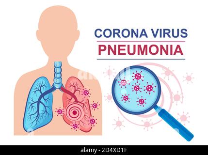 Signe vecteur de la maladie de pneumonie du virus Corona. Infection des poumons. Normal et affecté de la maladie pulmonaire.traitement inflammation système respiratoire humain. Illustration de Vecteur