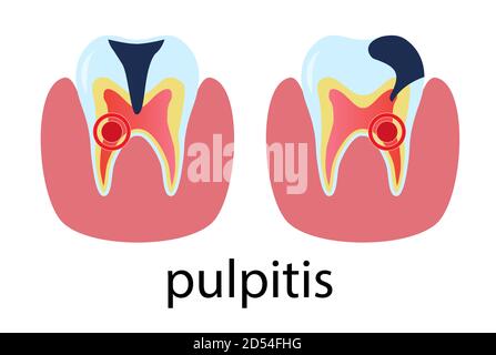 Affiche de traitement dentaire pulpitis. Dent molaire humaine de style plat. Illustration vectorielle isolée sur blanc. Illustration de Vecteur