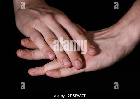 Homme main ongles endommagés. Ongles mordus. Soins des ongles. Manucure hommes. Problèmes de plaque à clous. Mains . Isolé sur un fond noir. Banque D'Images