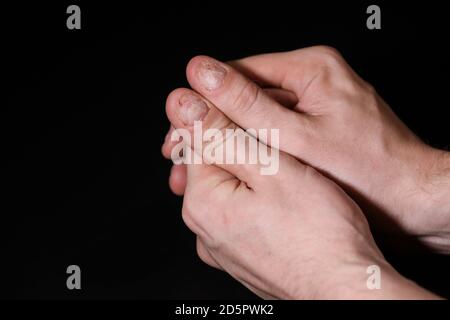 Homme main ongles endommagés. Ongles mordus. Soins des ongles. Manucure hommes. Problèmes de plaque à clous. Mains . Isolé sur un fond noir. Banque D'Images