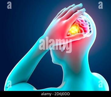 Douleur dans la tête, le cerveau et les synapses, problèmes cognitifs, déficit mental. Anévrisme. Maladies dégénératives affectant la région du cerveau. Parkinson et Alzh Banque D'Images