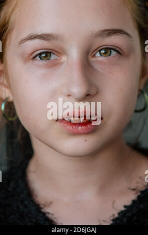 petite fille avec une lèvre cassée. Fille avec une lèvre cassée Banque D'Images