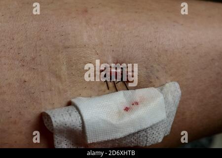 Plaie fraîche avec points de suture Banque D'Images