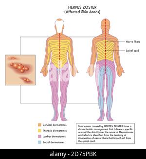 Schéma médical des zones cutanées affectées de Herpes Zoster avec annotations. Illustration de Vecteur