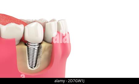 Dent humain implant unique concept dentaire dents ou prothèses dentaires humaines rendu 3d sur blanc Banque D'Images