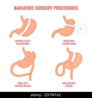 Types de chirurgie bariatrique, illustration conceptuelle. Types de chirurgie de perte de poids - dérivation gastrique, gastrectomie à manchon, et bande gastrique réglable. Banque D'Images