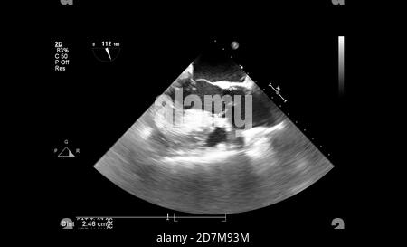 Image du cœur en mode échelle de gris pendant l'échographie transœsophagienne. Banque D'Images