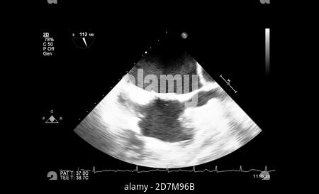 Image du cœur en mode échelle de gris pendant l'échographie transœsophagienne. Banque D'Images