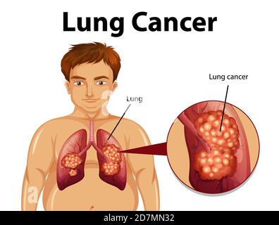 Illustration informative du cancer du poumon Illustration de Vecteur