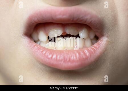 gros plan sur la partie inférieure du visage de l'enfant, une jeune fille ou un garçon de 7 ans montre des dents de lait et de croissance permanente. Mise au point sélective douce. Macro. CH Banque D'Images