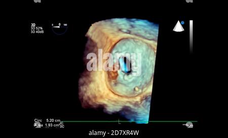 Image 3D du cœur pendant l'échographie transœsophagienne. Banque D'Images
