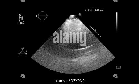 Image du cœur en mode échelle de gris pendant l'échographie transœsophagienne. Banque D'Images