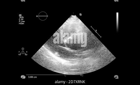 Image du cœur en mode échelle de gris pendant l'échographie transœsophagienne. Banque D'Images