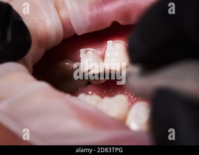 Gros plan de l'orthodontiste en plaçant les supports orthodontiques sur les dents du patient. Personne ayant un rétracteur de joue dans la bouche et des bretelles sur les dents ayant une procédure dentaire. Concept de stomatologie, traitement orthodontique. Banque D'Images