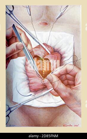 Santé et médecine ancienne illustration couleur: Entéroanastomose, établissement chirurgical d'une communication entre deux parties éloignées de l'intestin Banque D'Images