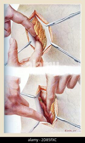 Soins de santé et médecine ancienne couleur illustration: L'ablation chirurgicale de l'appendice avec une incision ouverte dans l'abdomen (laparotomie) Banque D'Images