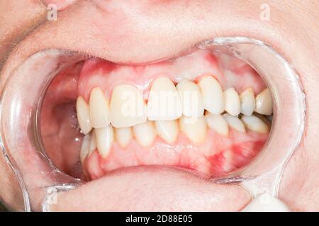 Gros plan de l'intérieur de la bouche et des plombages et des couronnes sur les dents, avec tartre à plaque. Besoin de blanchiment des dents. Au cabinet dentaire, avec la bouche ouverte Banque D'Images