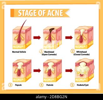 Étapes de l'illustration de l'anatomie de l'acné de peau Illustration de Vecteur