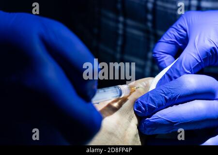 Série de traitement des ongles de crapaule incarnés. Médecin injectant un anesthésique local dans l'orteil Banque D'Images