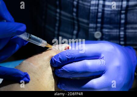 Série de traitement des ongles de crapaule incarnés. Médecin injectant un anesthésique local dans l'orteil Banque D'Images