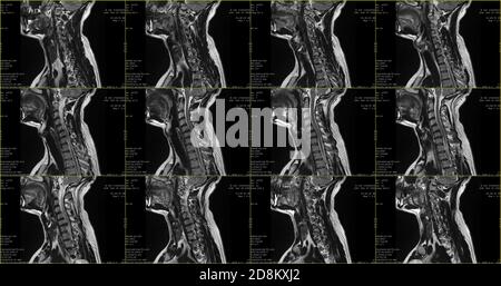 Ensemble d'acquisitions IRM sagittales de la zone du cou du caucase homme de 34 ans avec extrusion paramédiale bilatérale du Segment C6-C7 avec radiculopathie Banque D'Images