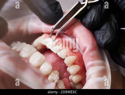 Gros plan de la main orthodontiste dans un gant noir mettant des bretelles sur les dents de la jeune femme. Patient avec un écarteur de joue dans la bouche et des supports orthodontiques sur les dents en visite à la clinique dentaire. Concept de la dentisterie. Banque D'Images