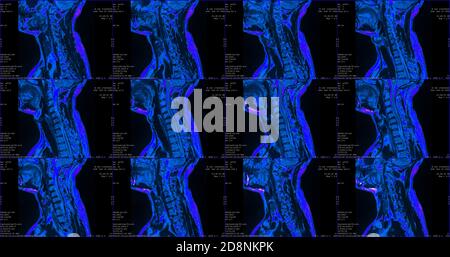 Jeu de 12 acquisitions IRM sagittales de couleur bleue du cou zone de caucasien 34 ans homme avec paramedial bilatéral Extrusion du segment C6-C7 Banque D'Images