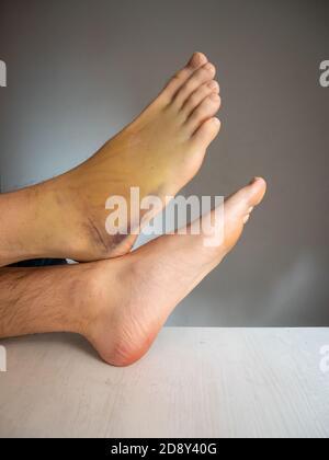 Ecchymose du pied droit, également connue sous le nom de Contusion sur une grande zone avec Banque D'Images