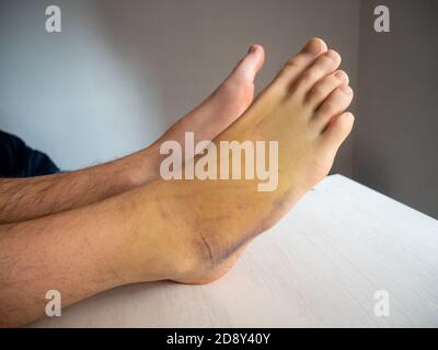 Ecchymose du pied droit, également connue sous le nom de Contusion sur une grande zone avec Banque D'Images