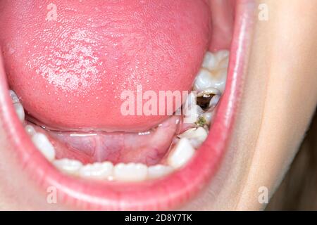 Caries précoces et dents décalées. Le concept de soins pour la cavité buccale. Gros plan de l'intérieur de la bouche et des plombages Banque D'Images